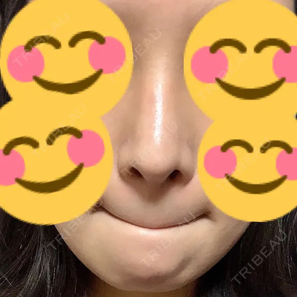 隆鼻術 / 鼻中隔延長（切開） / 眉間プロテーゼ プリモ麻布十番クリニック AFTER メイン用