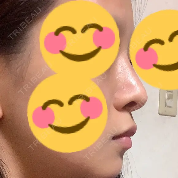 隆鼻術 / 鼻中隔延長（切開） / 眉間プロテーゼ プリモ麻布十番クリニック DAY 183 メイン用