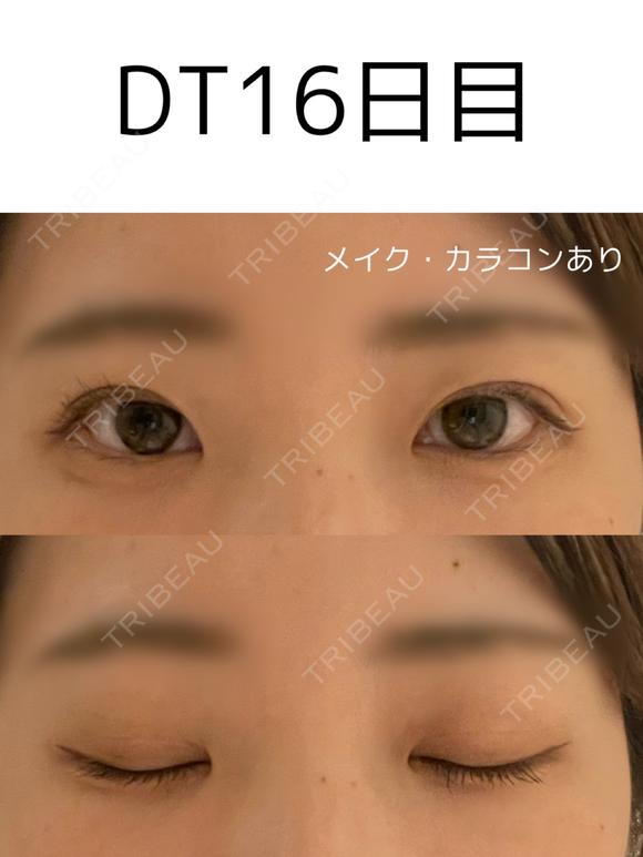 二重埋没 けやき美容クリニック 沼津院 DAY 16 メイン用