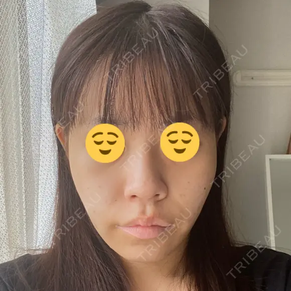 糸リフト ルラ美容クリニック 渋谷本院 AFTER メイン用