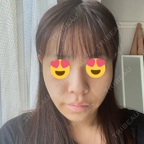 ヒアルロン酸溶解 ルラ美容クリニック 渋谷本院 AFTER メイン用
