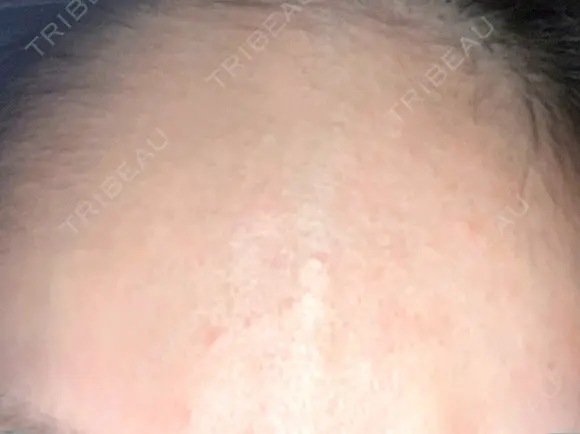 その他 Wクリニック 梅田院 AFTER メイン用