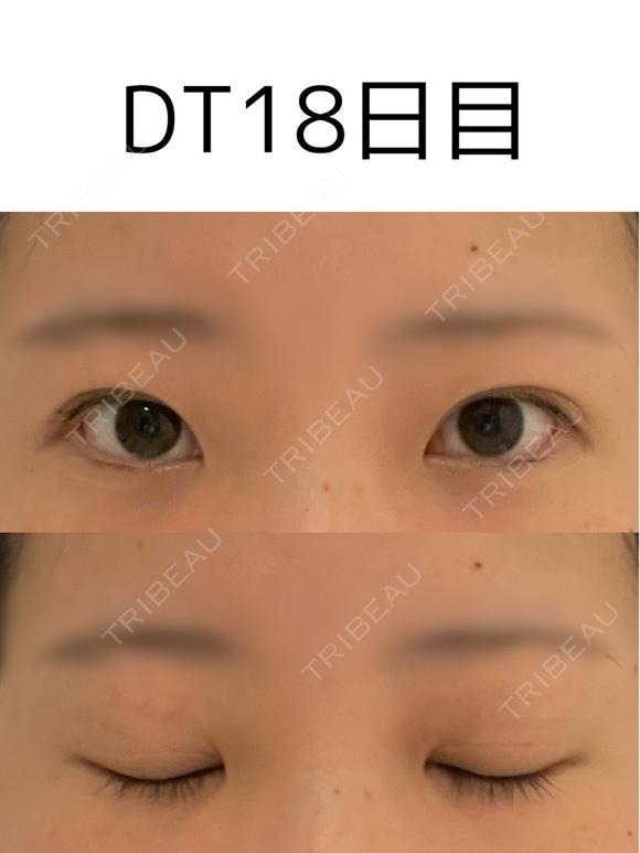 二重埋没 けやき美容クリニック 沼津院 DAY 18 メイン用