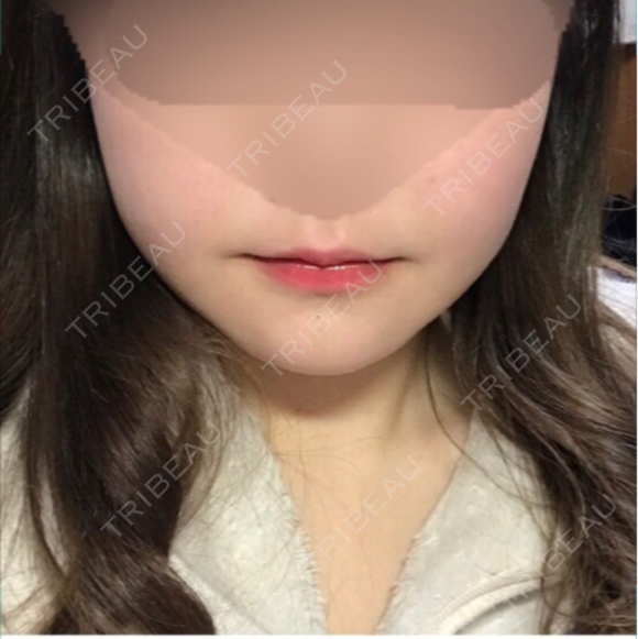 骨切り（あご） / 骨削り（エラ） / 骨削り（頬） id（アイディ）美容外科 AFTER メイン用