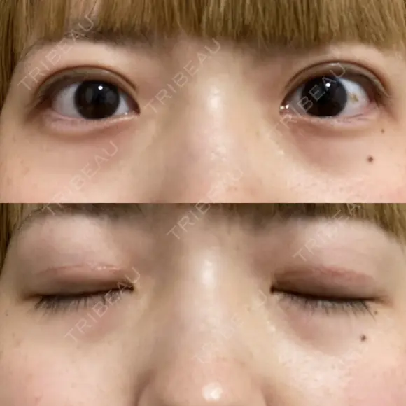 二重切開 松下皮フ形成外科 DAY 38 メイン用