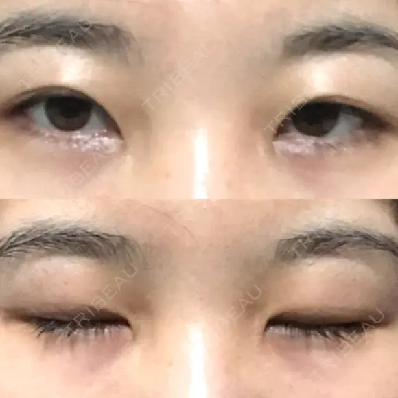二重切開 / 眼瞼下垂（切開） ブリスクリニック形成外科・美容外科・美容皮膚科 福岡 DAY 204 メイン用