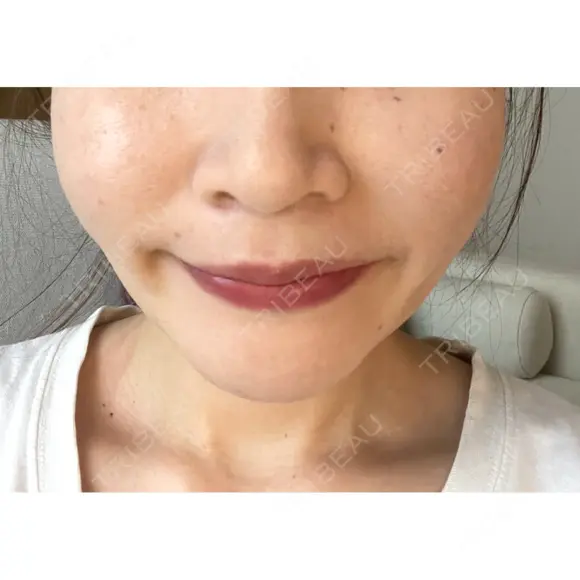 バッカルファット除去 / 脂肪吸引（顔） EMMA CLINIC（エマクリニック） DAY 31 メイン用