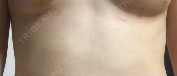 脂肪吸引（お腹） / 脂肪吸引（お尻） / 豊胸（脂肪注入） / その他（ボディ） ドクターフィット（Dr.fit）クリニック DAY 17 メイン用