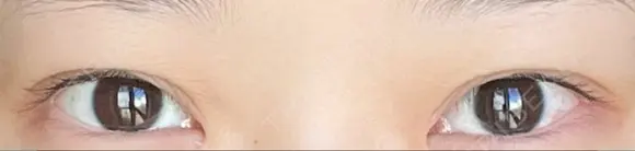 二重切開 / 上まぶたの脂肪取り 松下皮フ形成外科 AFTER メイン用