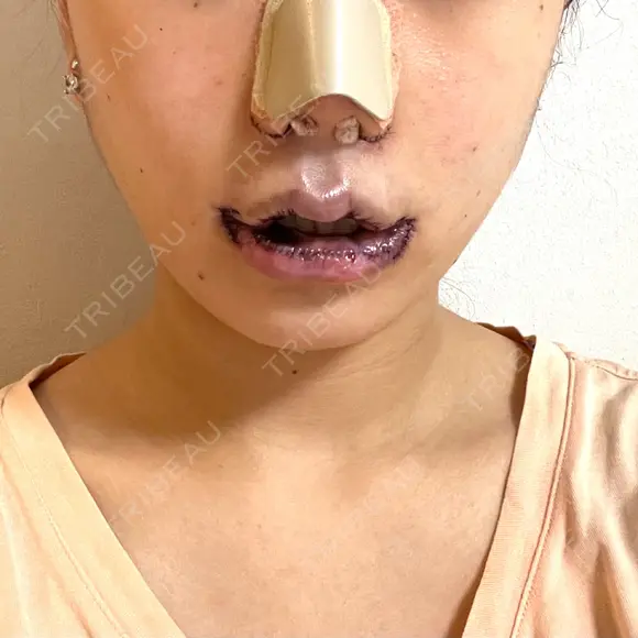 小鼻縮小（切開） / 口唇縮小術 / 口角挙上 / その他（鼻） / その他（口元） B-LINE CLINIC 池袋院 DAY 0 メイン用