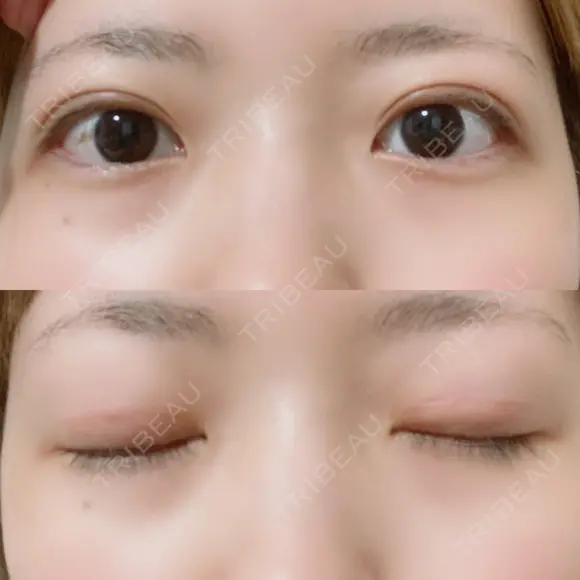 二重切開 松下皮フ形成外科 DAY 45 メイン用