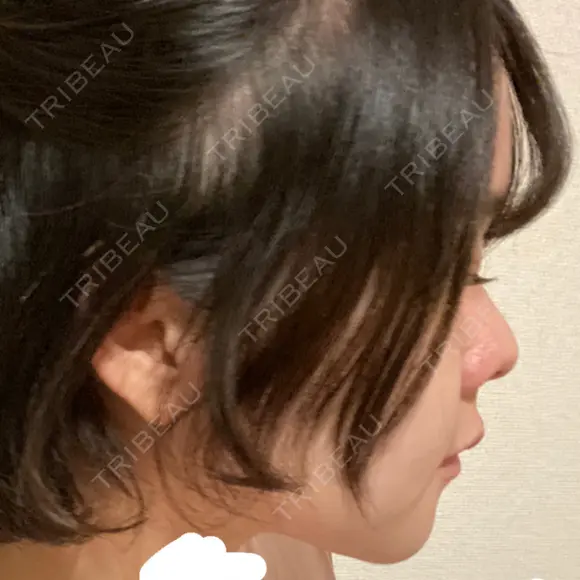セットバック 大塚美容形成外科・歯科 大塚本院 DAY 45 メイン用