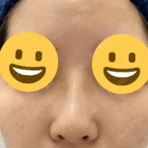 隆鼻術 サラ美容外科 DAY 6 メイン用