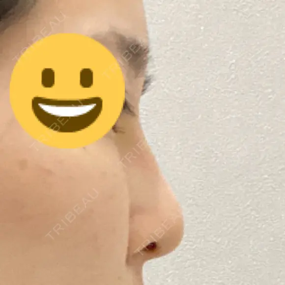 隆鼻術 サラ美容外科 DAY 6 メイン用