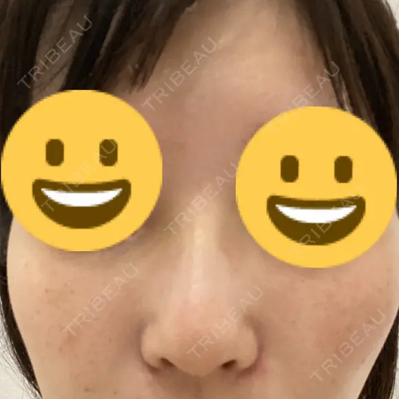 隆鼻術 サラ美容外科 DAY 7 メイン用