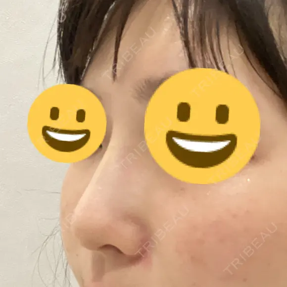 隆鼻術 サラ美容外科 DAY 7 メイン用