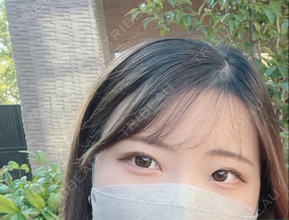 二重埋没 けやき美容クリニック 沼津院 DAY 27 メイン用