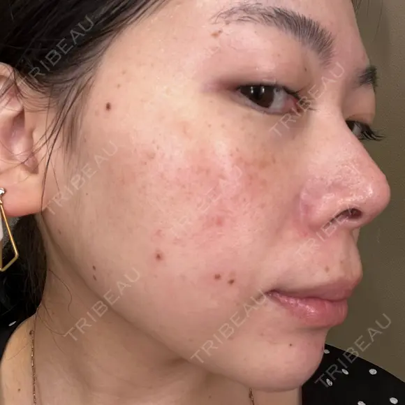 ルメッカ La Clinique Shinjuku 【ラクリニック 新宿】 DAY 0 メイン用