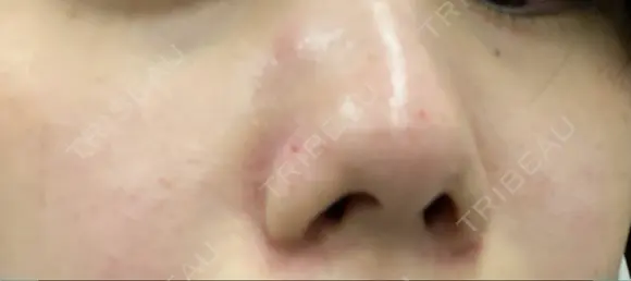 毛穴洗浄（ハイドラフェイシャルなど） TRUE DESIGN CLINIC DAY 0 メイン用