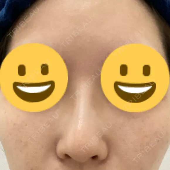 隆鼻術 サラ美容外科 AFTER メイン用