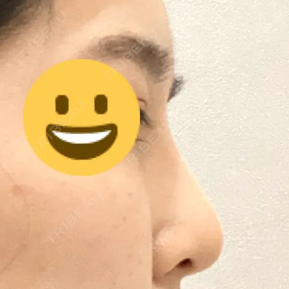 隆鼻術 サラ美容外科 DAY 14 メイン用