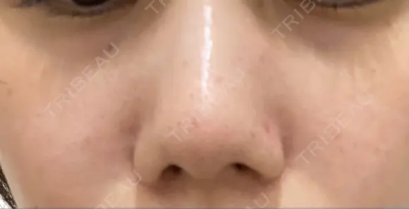 毛穴洗浄（ハイドラフェイシャルなど） TRUE DESIGN CLINIC AFTER メイン用