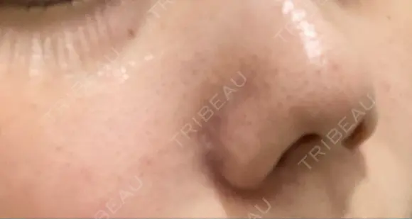 毛穴洗浄（ハイドラフェイシャルなど） TRUE DESIGN CLINIC DAY 1 メイン用