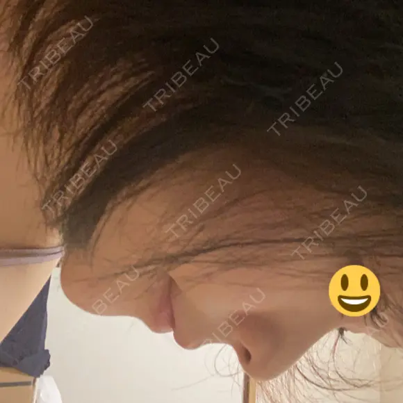 セットバック 大塚美容形成外科・歯科 大塚本院 DAY 49 メイン用