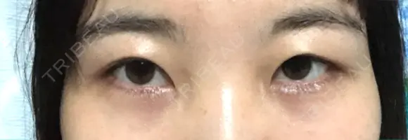 二重切開 / 眼瞼下垂（切開） ブリスクリニック形成外科・美容外科・美容皮膚科 福岡 DAY 227 メイン用