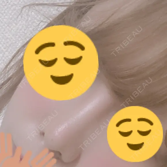 隆鼻術 / 鼻尖形成（切開） / 小鼻縮小（切開） / 骨切幅寄せ オペラ整形外科 DAY 82 メイン用