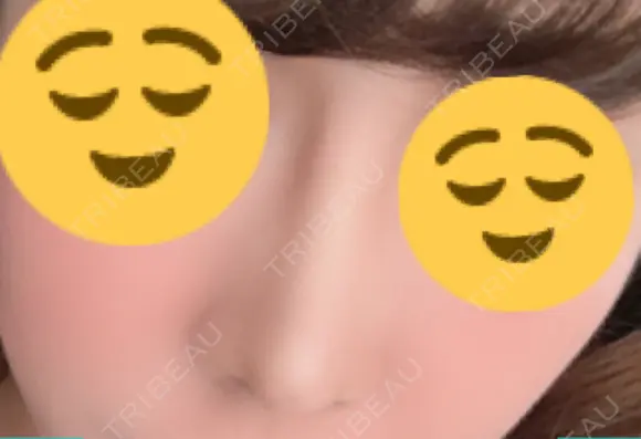 隆鼻術 / 鼻尖形成（切開） / 小鼻縮小（切開） / 骨切幅寄せ オペラ整形外科 AFTER メイン用