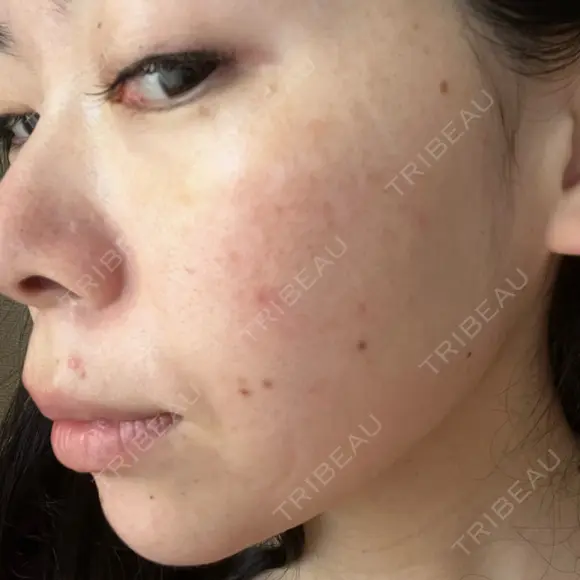 ルメッカ La Clinique Shinjuku 【ラクリニック 新宿】 DAY 8 メイン用