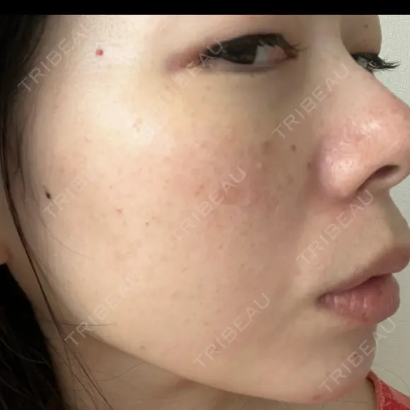 ルメッカ La Clinique Shinjuku 【ラクリニック 新宿】 DAY 8 メイン用