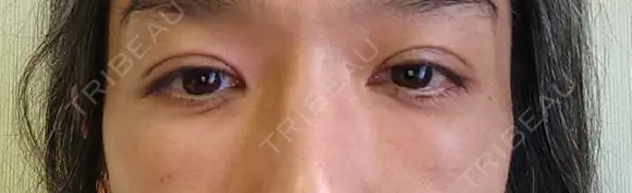 クマ治療 / 下まぶたたるみ取り / 下まぶたの脂肪取り セオリークリニック DAY 1 メイン用