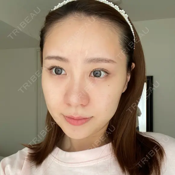 水光注射（ハリ・美肌） 表参道ウィズ・クリニック AFTER メイン用