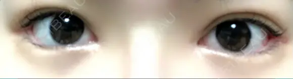 目頭切開 / 眼瞼下垂（切開） / 目尻切開 / 上まぶたの脂肪取り / タレ目形成・グラマラスライン（切開） BIANCA銀座 DAY 93 メイン用