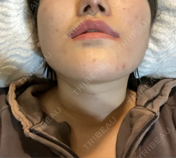 鼻尖形成（切開） / 軟骨移植 あつぎ美容クリニック DAY 23 メイン用