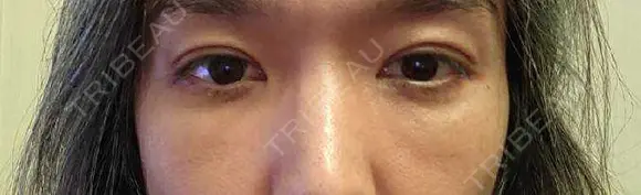 クマ治療 / 下まぶたたるみ取り / 下まぶたの脂肪取り セオリークリニック DAY 7 メイン用