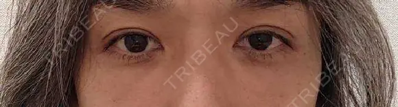 クマ治療 / 下まぶたたるみ取り / 下まぶたの脂肪取り セオリークリニック DAY 31 メイン用