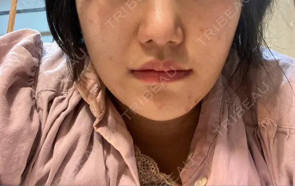 鼻尖形成（切開） / 軟骨移植 あつぎ美容クリニック DAY 25 メイン用