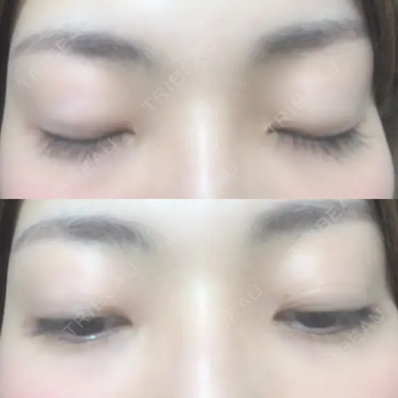 二重切開 松下皮フ形成外科 AFTER メイン用
