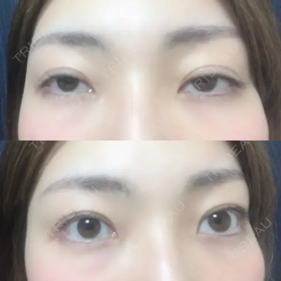 二重切開 松下皮フ形成外科 DAY 195 メイン用