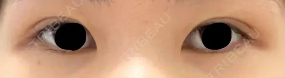 二重切開 松下皮フ形成外科 DAY 7 メイン用