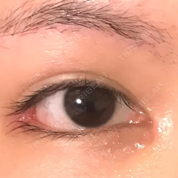 目頭切開 / 目尻切開 / 目尻靭帯移動 FROM B整形外科 (旧バウム整形外科) DAY 20 メイン用