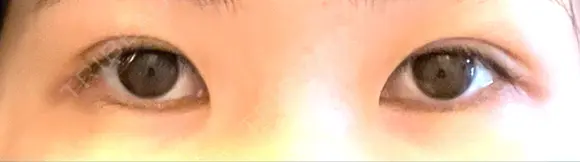 二重切開 松下皮フ形成外科 DAY 8 メイン用