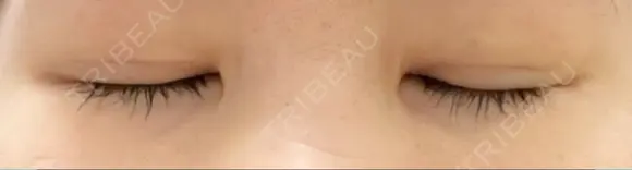 二重切開 松下皮フ形成外科 DAY 8 メイン用