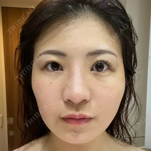 エレクトロポレーション / 毛穴洗浄（ハイドラフェイシャルなど） スキンシアクリニック AFTER メイン用