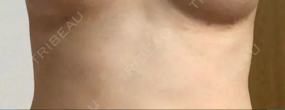 脂肪吸引（お腹） / 脂肪吸引（お尻） / 豊胸（脂肪注入） / その他（ボディ） ドクターフィット（Dr.fit）クリニック AFTER メイン用