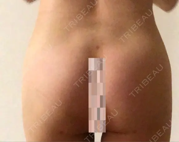 脂肪吸引（お腹） / 脂肪吸引（お尻） / 豊胸（脂肪注入） / その他（ボディ） ドクターフィット（Dr.fit）クリニック DAY 22 メイン用