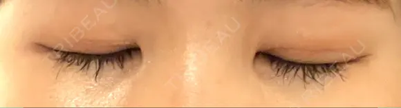 二重切開 松下皮フ形成外科 DAY 9 メイン用